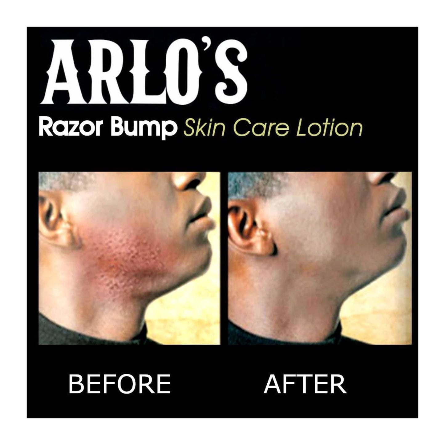 Arlo's Razor Bump Skin Care Lotion 177ml bottle for soothing razor bumps and razor burn